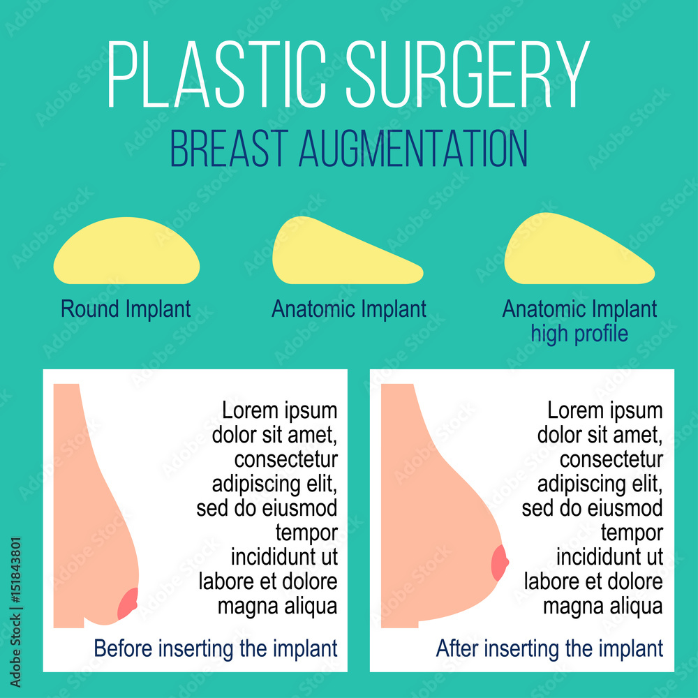 Plastic Breast Surgery Vector Illustration Types Of Breast Implants 