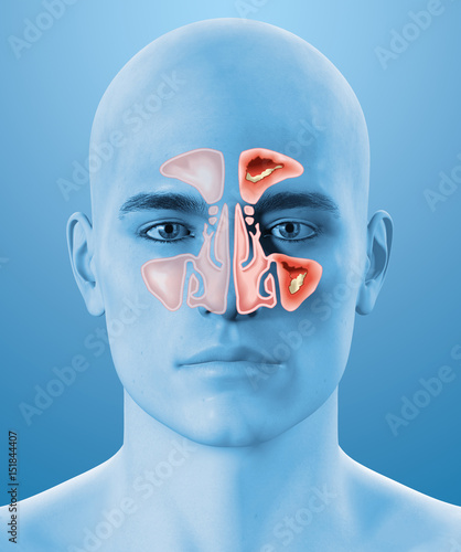 Paranasal sinusitis, nasal cavity, flu, illustration photo