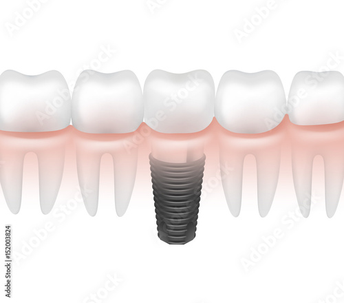 Metal tooth implant