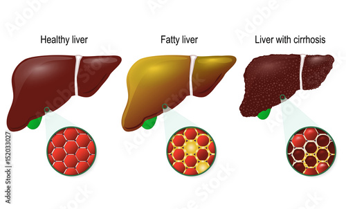 Healthy, fatty and cirrhosis of the liver