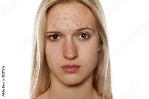 Young blonde with pimples on her forehead photo