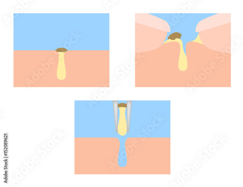 finger squeeze acne out vector