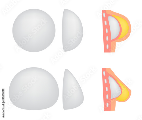 breast implant . cosmetic surgery vector