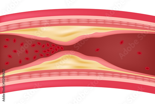 step of Atherosclerosis icon and vector . fat stuck in the blood artery  cholesterol
