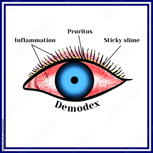 Demodex. Parasitic eye disease.