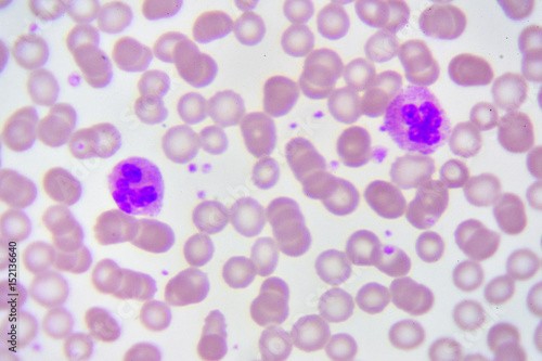 Neutrophil cell (white blood cell) in blood smear, analyze by microscope 