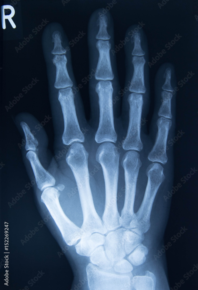 Röntgenaufnahme einer Hand Röntgenaufnahme einer Hand