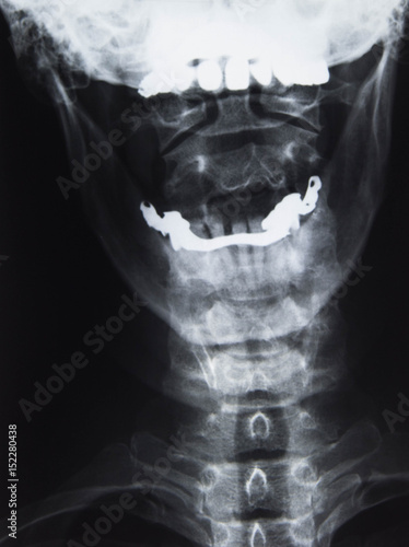Röntgenbild, Halswirbelsäule und Zähne