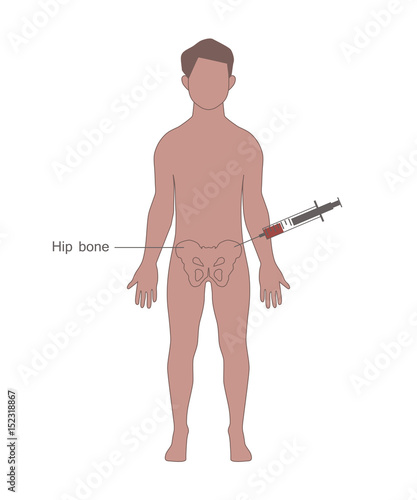 Harvesting Bone Marrow From the Donor