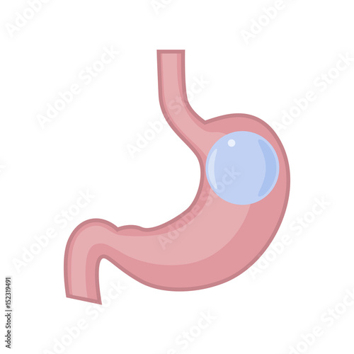 Gastric Balloon Stomach