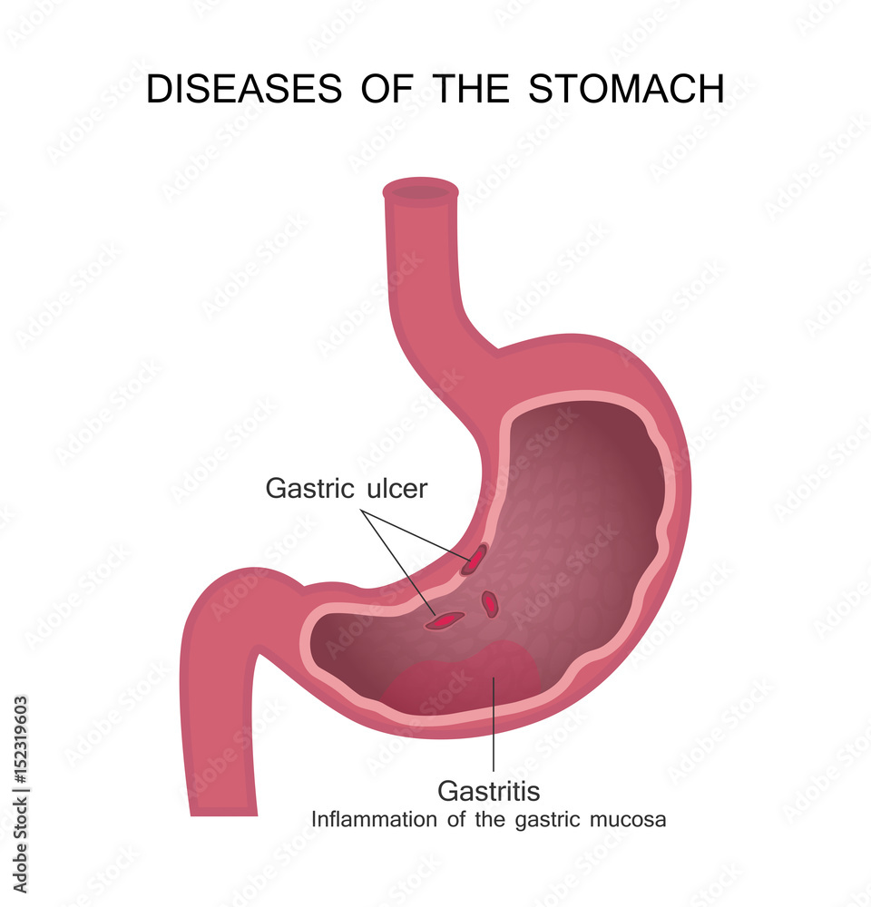 Diseases of the Stomach. Peptic Ulcer and Gastritis. vector de Stock