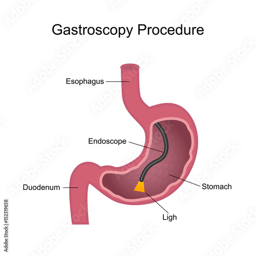 Gastroscopy Procedure Diagram