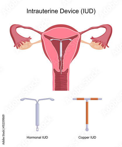 Intrauterine Device IUD