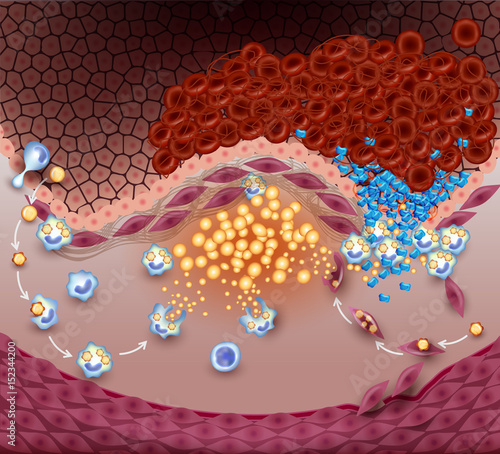 Thrombus, blood clot, unstable plaque rupture. Illustrative diagram how atherosclerosis is progressing till plaque rupture, artery lumen is narrowed and lead to thrombosis and arterial occlusion.