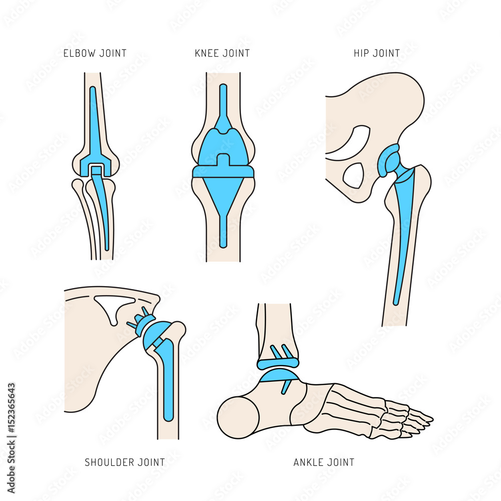 Medical illustration of the implantation of the bone joints in the human  skeleton. Layout of implants, artificial joints, in different parts of the  human body Stock Vector | Adobe Stock