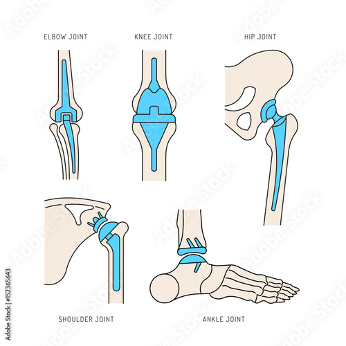 Medical illustration of the implantation of the bone joints in the human skeleton. Layout of implants, artificial joints, in different parts of the human body