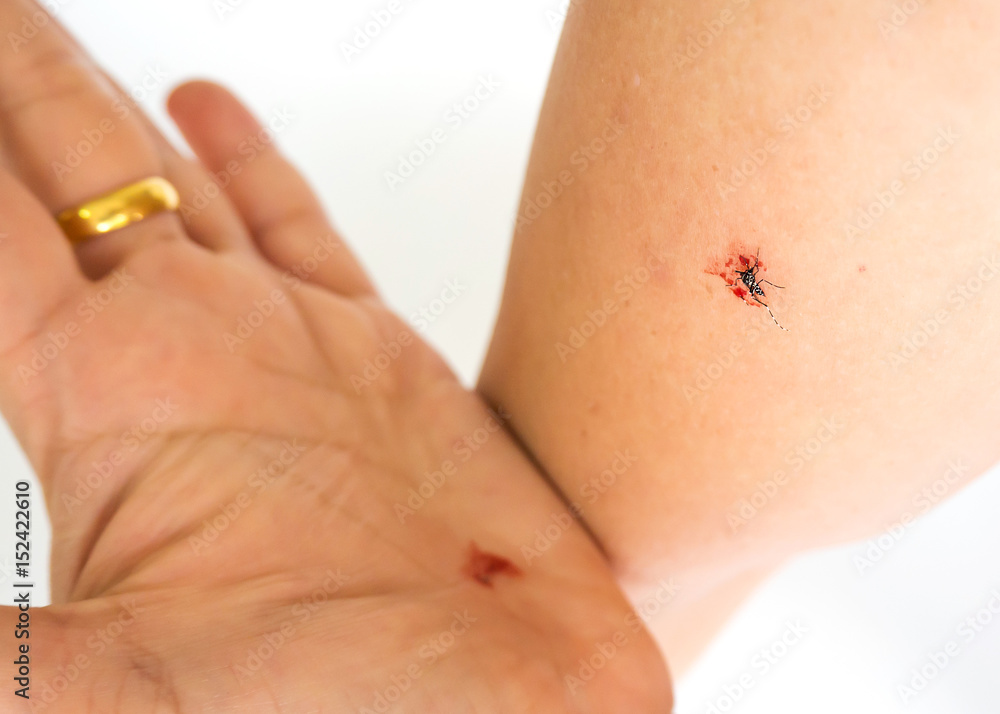 Mosquito death on woman arm. After hit by her palm. Mosquito death on woman arm. After hit by her palm.