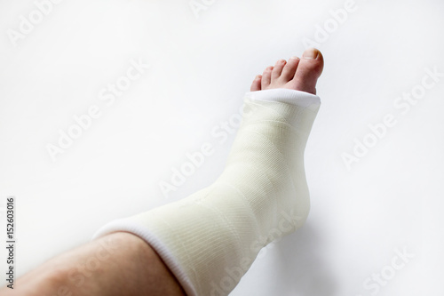 leg in plaster