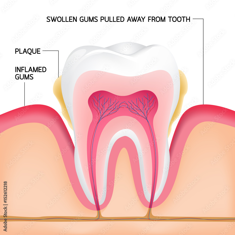 Inside on a single tooth with gums.Human tooth cross-section. Dental plaque problem, illustration. Inside on a single tooth with gums.Human tooth cross-section. Dental plaque problem, illustration.