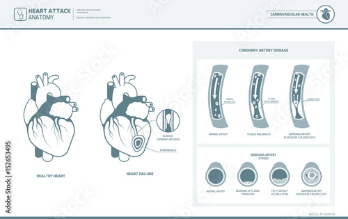 Anatomy of a heart attack