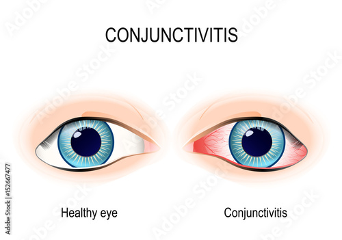Conjunctivitis