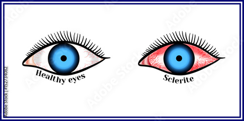Sclerite. Inflammatory disease of sclera.