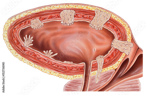 Cancer of the urinary bladder and bladder wall, cutaway side view. 