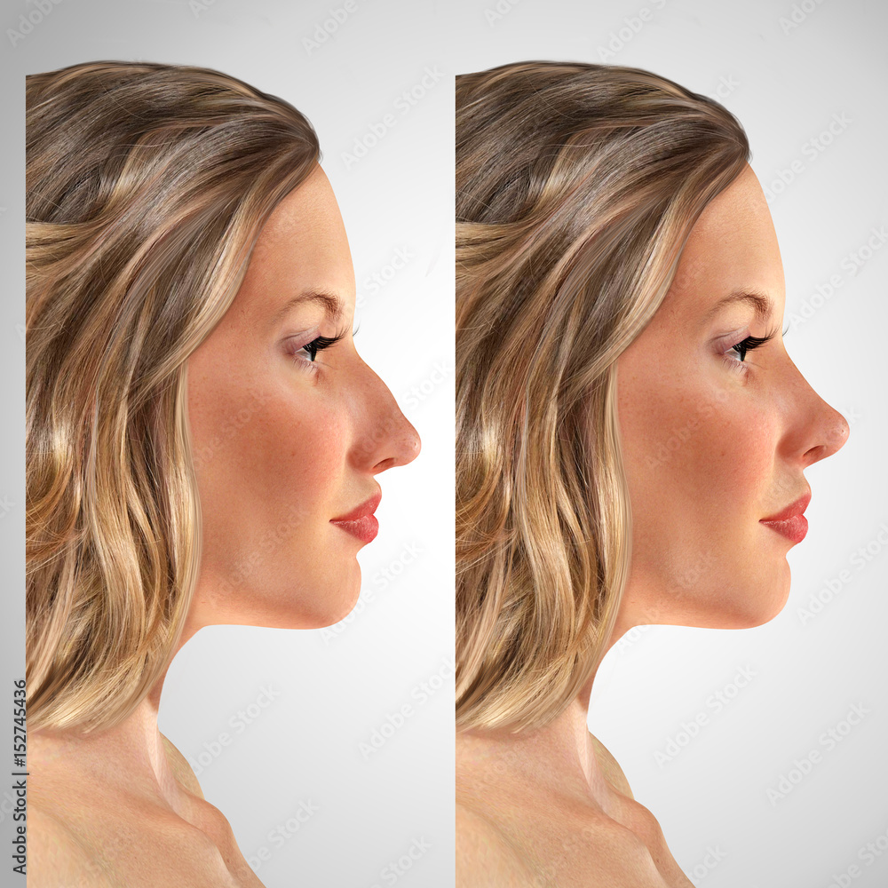 comparative portrait of a 3d young woman before and after rhinoplasty comparative portrait of a 3d young woman before and after rhinoplasty