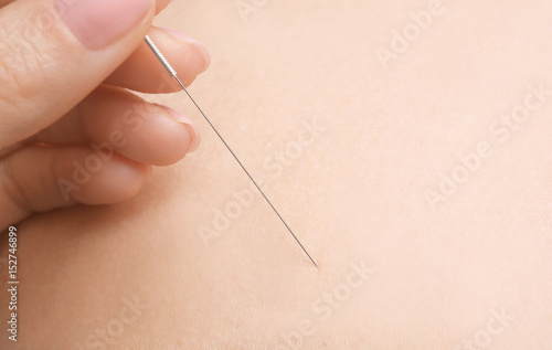 Woman stimulating acupuncture points on patient s back  closeup