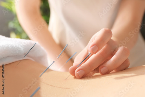 Fototapeta Naklejka Na Ścianę i Meble -  Young woman undergoing acupuncture treatment, closeup