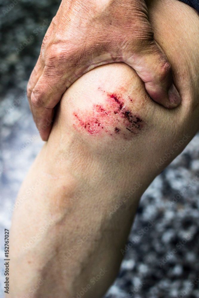 Fototapeta premium Knee after a fall