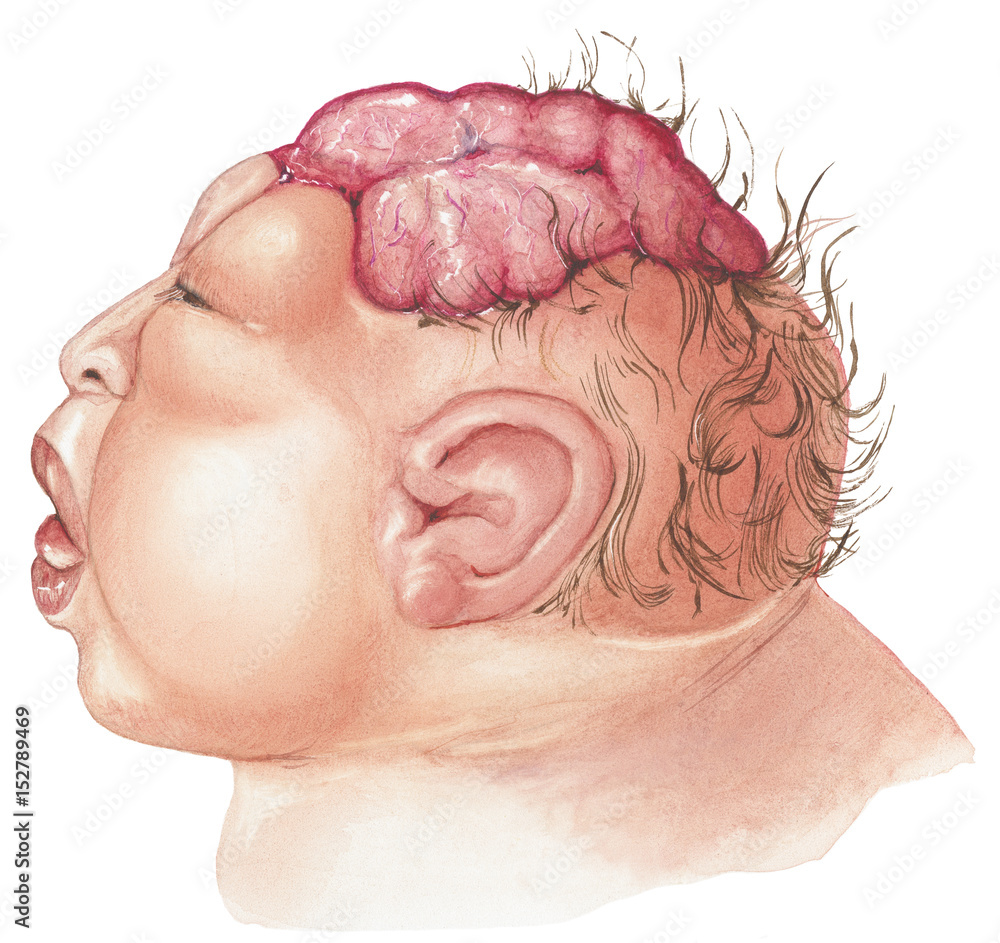 Anencephaly is the absence of a large part of the brain and the skull