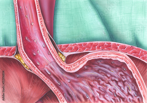 Gastroesophageal reflux disease (GERD), caused when the lower esophageal sphincter (LES) does not close properly, and stomach contents leak back (reflux) into the esophagus. photo