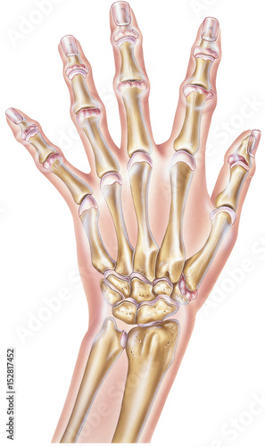 Shown is a hand with moderate arthritis of some of the joints, This would cause joint stiffness and pain as well as a reduction in range of motion.