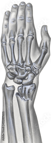 Shown is a hand, wrist and forearm with a broken radius bone.
