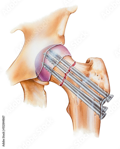 Illustration of a hip fracture repair. Shown is a fracture of the femoral neck that was repaired with multiple cancellous screws.. photo