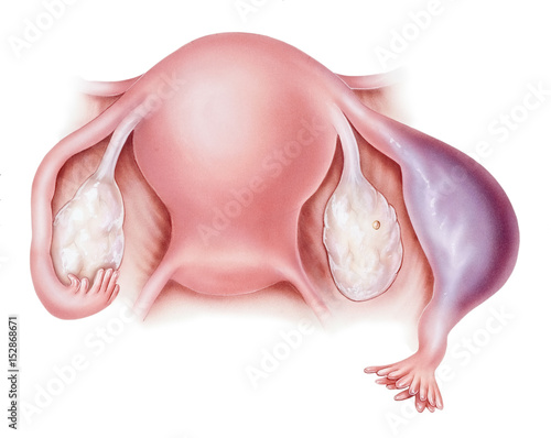 An ectopic pregnancy.  photo