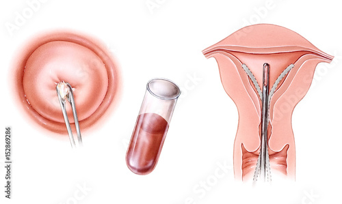 Pregnancy - Infertitlity Tests. Postcoital test (left), blood hormone test (middle), and endometrial biopsy (right). photo