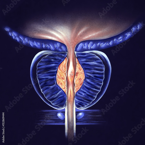 Prostate Gland - (BPH) Benign Prostatic Hyperplasia, Stage 1 - false color to highlight details..