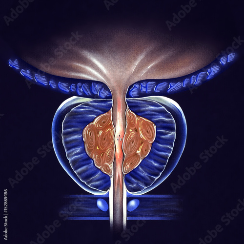 Prostate Gland - (BPH) Benign Prostatic Hyperplasia, Stage 2 - false color to highlight details