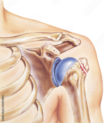Shoulder - Broken Greater Tubercle. Anatomy of the bones and joints of a shoulder with a broken greater tubercle. photo