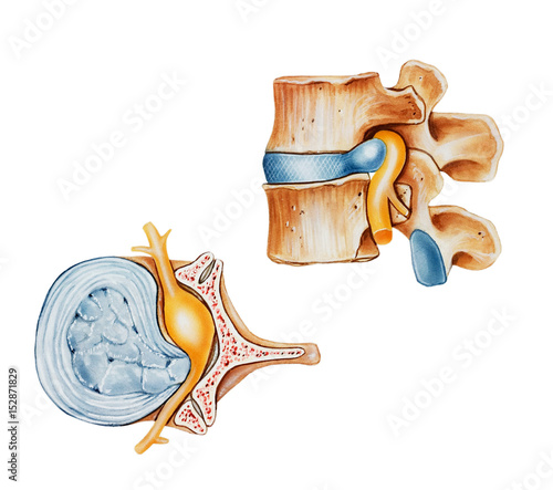 A herniated (slipped or ruptured) disc, side (top) and top (left) views. Shown is a ruptured.disc with the nucleus coming out of the annulus