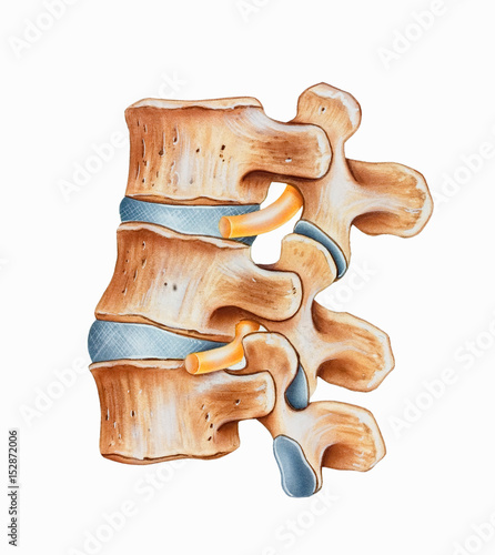 Фотография Spine - Lumbar Hyperlordosis is an exaggerated curvature of the lumbar spine most often involving the L3, L4, and L5 vertebrae