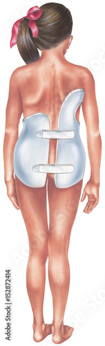 Spine - Scoliosis - Young Girl in Scoliosis Spinal Brace - posterior view.
