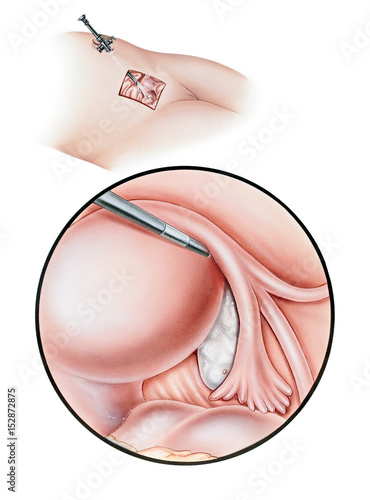 Surgery - Diagnostic Laparoscopy. Shown are broad cutaway (top) and close up (bottom) views that depict the laparoscope, fallopian tube, fibria, ovary, and uterus. photo