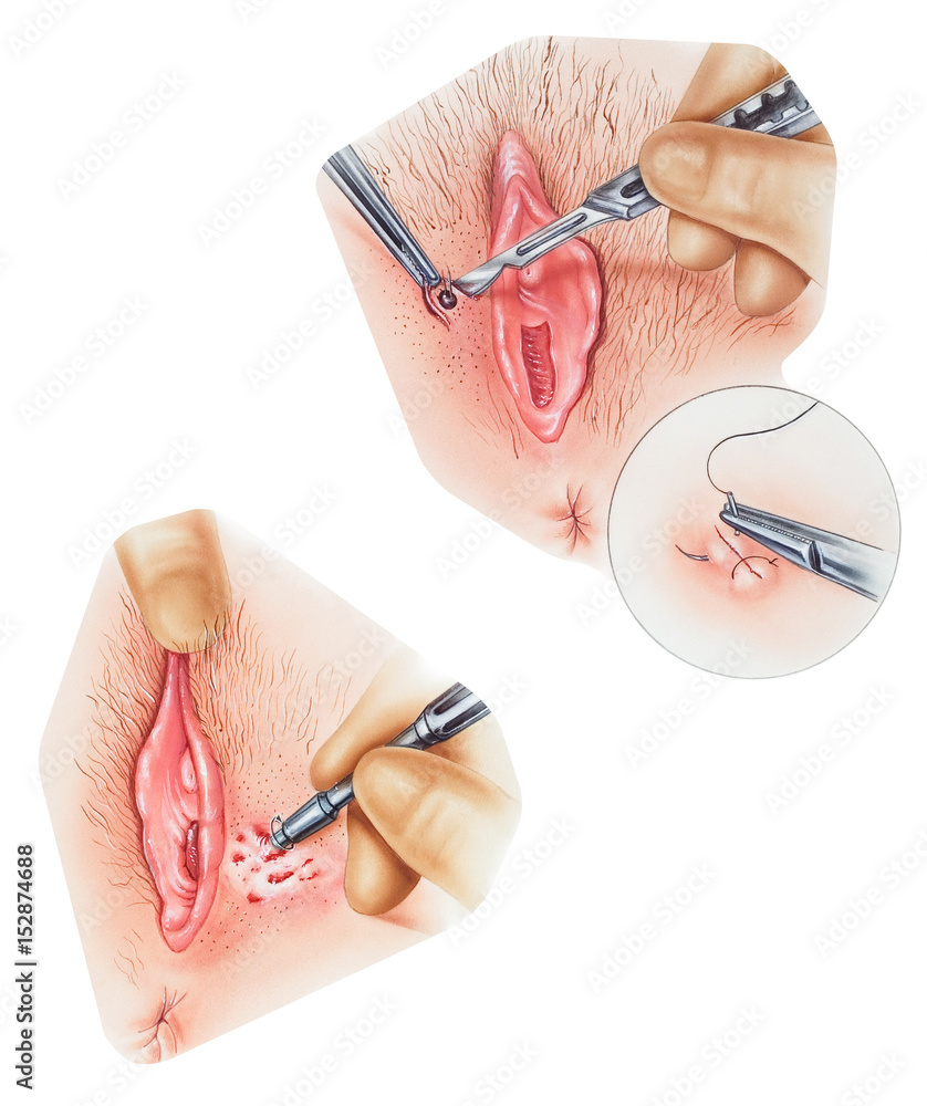 Vagina - Biopsy of the Vulva Stock Illustration | Adobe Stock