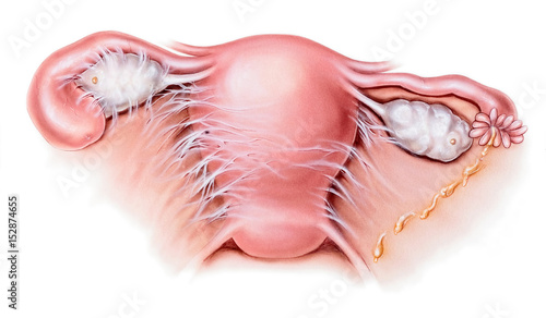 Uterus - Pelvic Inflammatory Disease (PID)