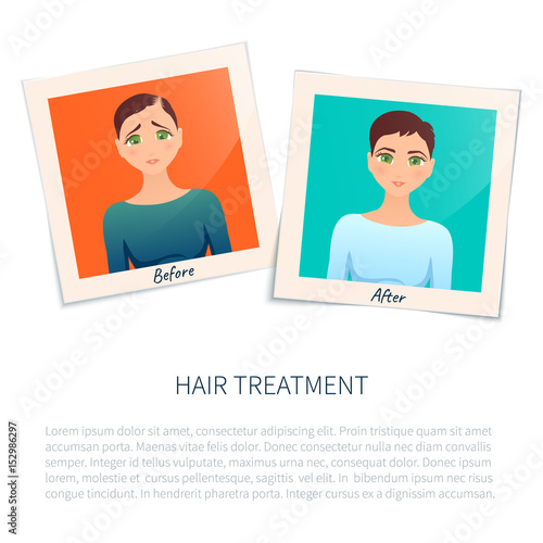 Vector illustration of two photographs of a woman before and after hair treatment and transplantation. Female alopecia stages design template with place for text. Medical concept. 