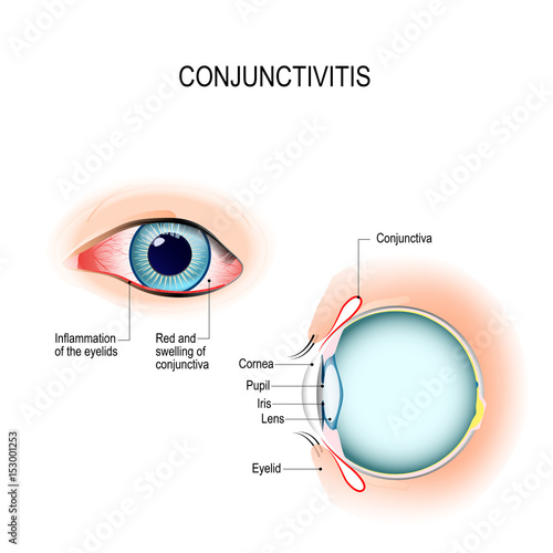 Conjunctivitis. External View and Vertical section of the human eyes