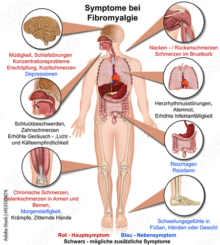 Symptome bei Fibromyalgie photo